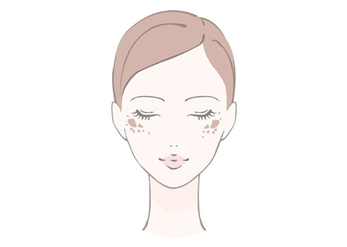 後天性真皮メラノサイトーシス（ADM）