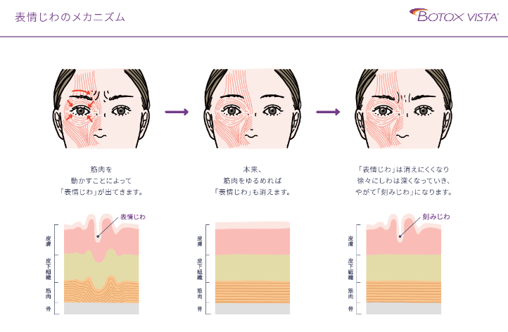 表情ジワのメカニズム BOTOX VISTA にんにくを動かすことによって「表情じわ」が出てきます。皮膚 皮下組織 筋肉 骨 表情じわ 本来、筋肉をゆるめれば「表情じわ」も消えます。皮膚 皮下組織 筋肉 骨 「表情じわ」は消えにくくなり徐々にしわは深くなっていき、やがて「刻みじわ」になります。 皮膚 皮下組織 筋肉 骨 刻みじわ