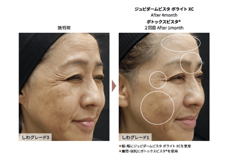 施術前 シワグレード3 ジュビタームビスタ ボライト XC After 4month ボトックスビスタ® 2回目 After 1month シワグレード1 額-頬にジュビタームビスタ ボライトXCを使用 眉間・目尻にボトックスビスタ®を使用