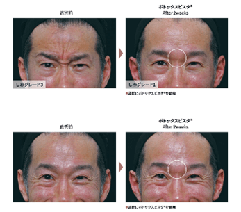 施術前 シワグレード3 ボトックスビスタ® 2回目 After 2month ワグレード1 眉間にボトックスビスタ®を使用 施術前 ボトックスビスタ® 2回目 After 2month 眉間にボトックスビスタ®を使用