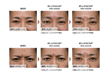 c ボトックスビスタ® 2回目 After 2weaks 目尻しわグレード0 目尻にボトックスビスタ®を使用 ボトックスビスタ® After 1month 目尻しわグレード0 眉間にボトックスビスタ®を使用 施術前 目尻しわグレード2 ボトックスビスタ® After 2weaks 眉間しわグレード2 眉間にボトックスビスタ®を使用 ボトックスビスタ® After 1month 眉間しわグレード0 眉間にボトックスビスタ®を使用