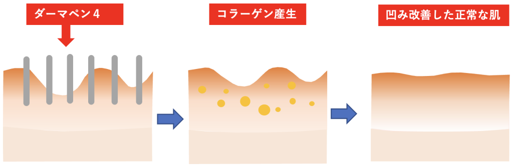 施術について