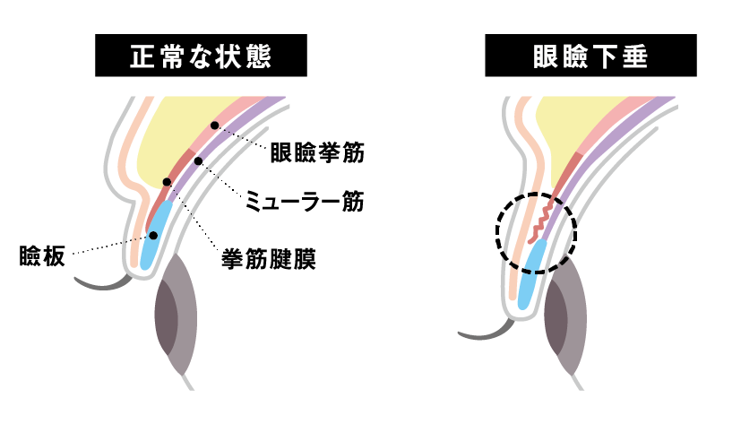 まぶたの仕組みと眼瞼下垂症の原因