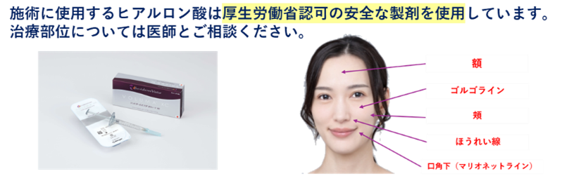 施術に使用するヒアルロン酸は厚生労働省認可の安全な製剤を使用しています。治療部位については医師とご相談ください。額 ゴルゴライン 頬 ほうれい線 口角下（マリオネットライン）