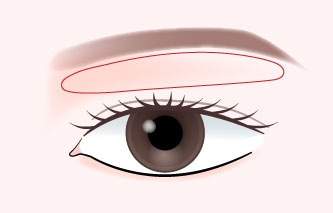 上まぶたのたるみ除去について