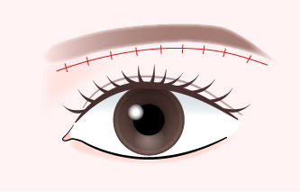 術後の縫合について