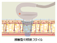 細やかな設定 接触型の照射スタイル