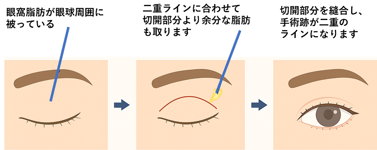 眼窩脂肪が眼球周囲に被っている 二重ラインに合わせて切開部分より余分な脂肪も取ります 切開部分を縫合し、手術痕が二重のラインになります