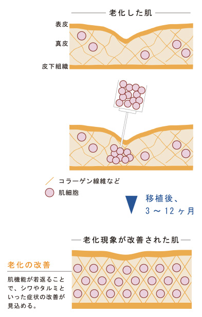 大量に移植したあなた自身の元気な肌細胞が老化した肌を修復します